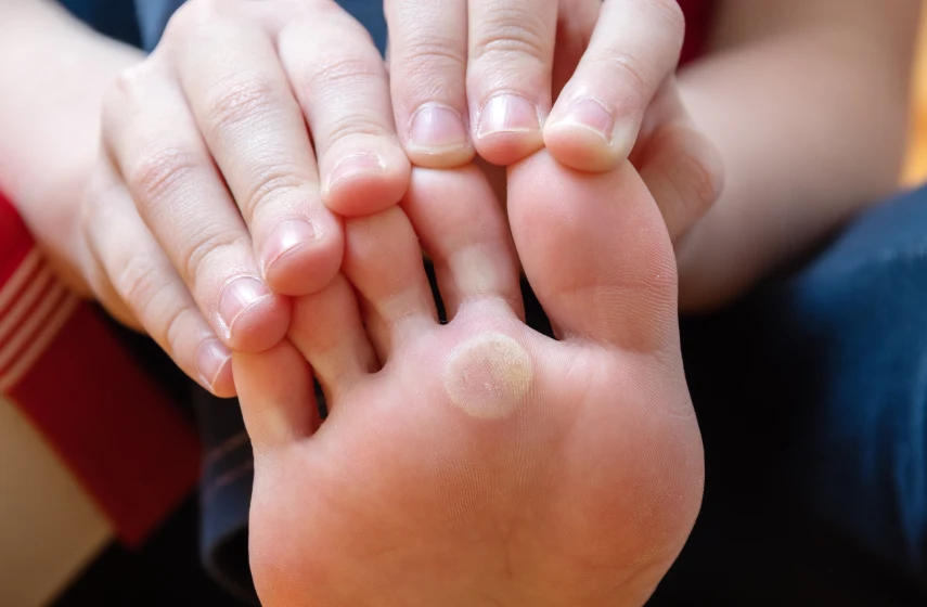  Diabetic foot care specialist examining a patient's foot for corn removal. 